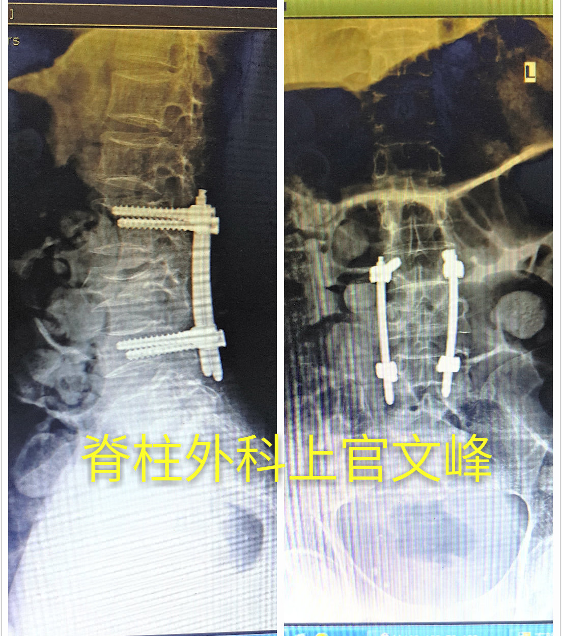 經皮置釘內固定術治療胸腰椎爆裂性骨折病例分享