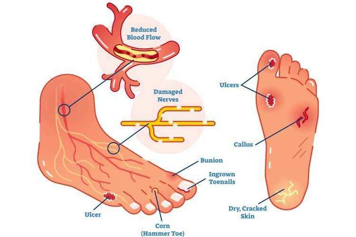 糖尿病患者足部受傷如何正確處理
