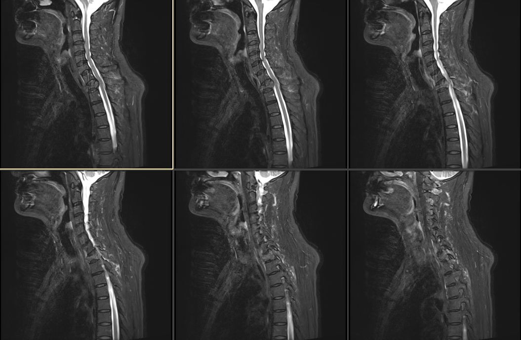 胸椎脊柱转移瘤胸1病例分享