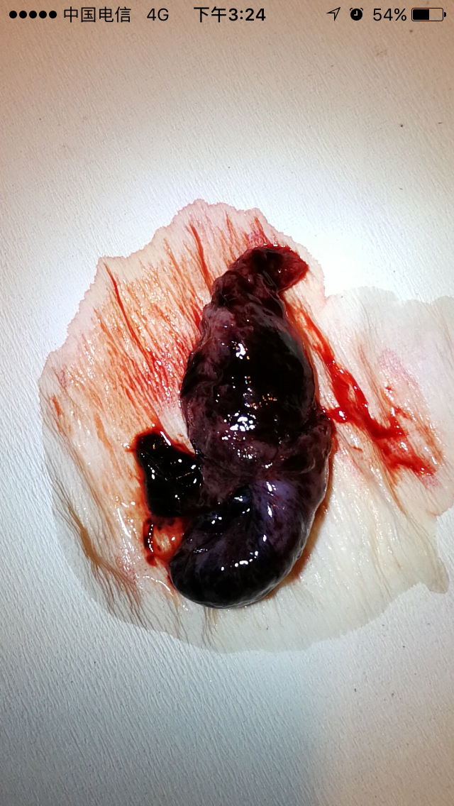 没有胞衣单纯的孕囊,不认为流产成功.