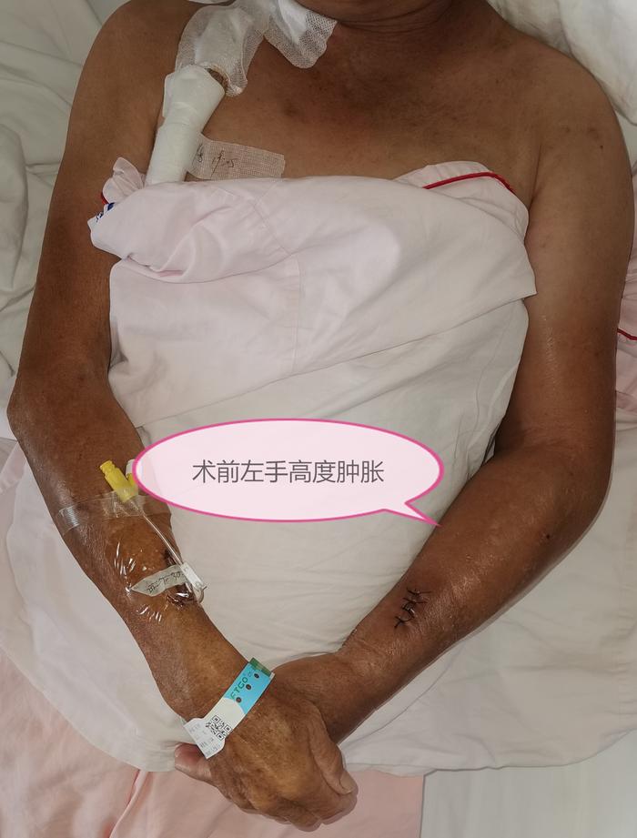少见 造瘘后一周出现肿胀手_吴太东医生文章_东莞康华医院-微医