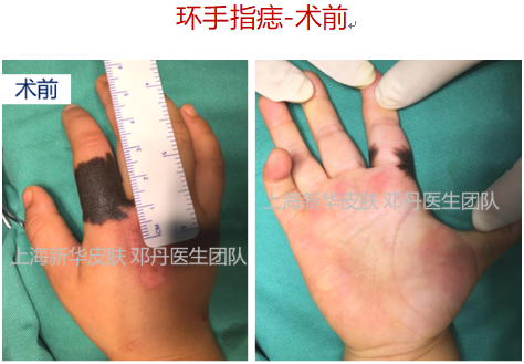 病例系列10环手指痣切除vs植皮