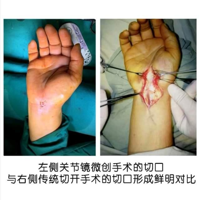 我在临床逐步推进内镜下腕管减压术,在腕关节镜下手术治疗腕管综合征