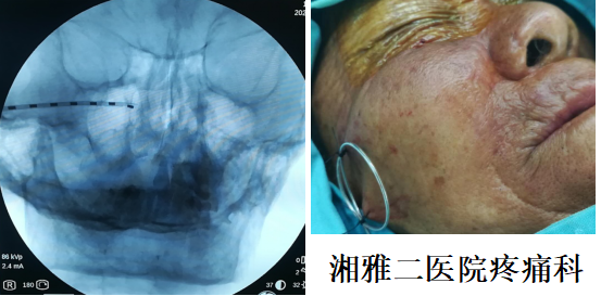 湘雅二医院疼痛科实施眶下神经电刺激治疗带状疱疹后三叉神经痛