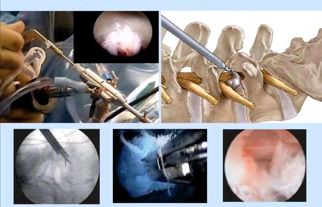 椎间孔镜手术是一种前沿的疼痛治疗方法,正在改变我们对疼痛治疗的