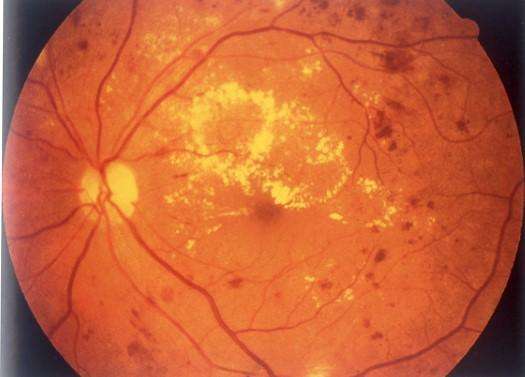 哪些病人应该进行眼底血管造影检查?