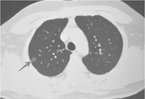 肺部ct有结节