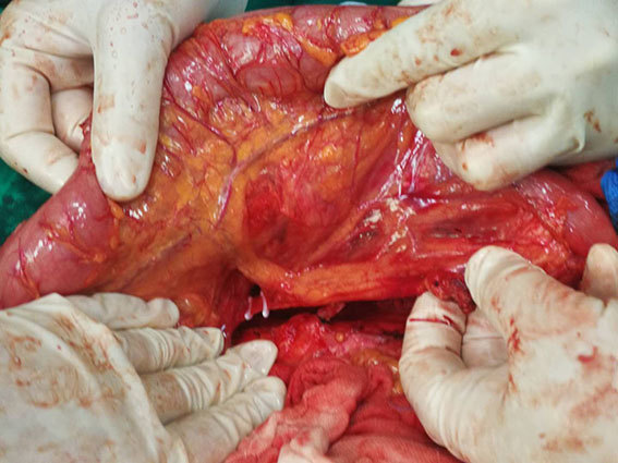 直肠癌保肛术后再发直肠肿瘤行再次保肛手术_黄平医生文章_江苏省人民