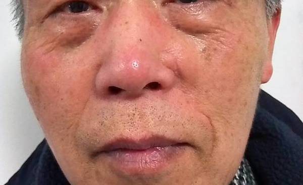 鼻面部的皮肤肿瘤在切除后都需要进行修复与重建,尤其是外鼻,这里的