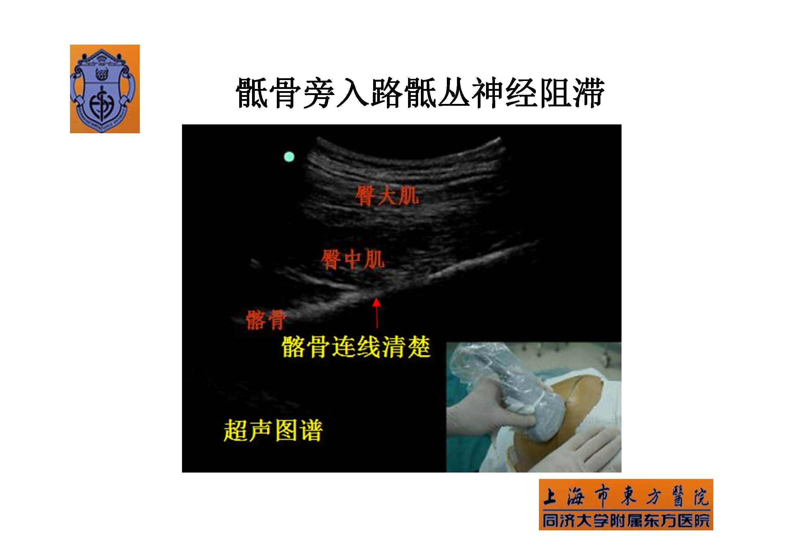 实用骶丛神经阻滞