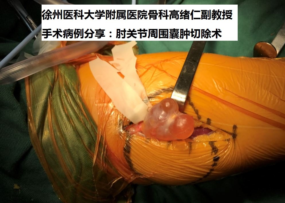 徐州二院骨科专家高绪仁手术病例分享:肘关节周围囊肿切除.