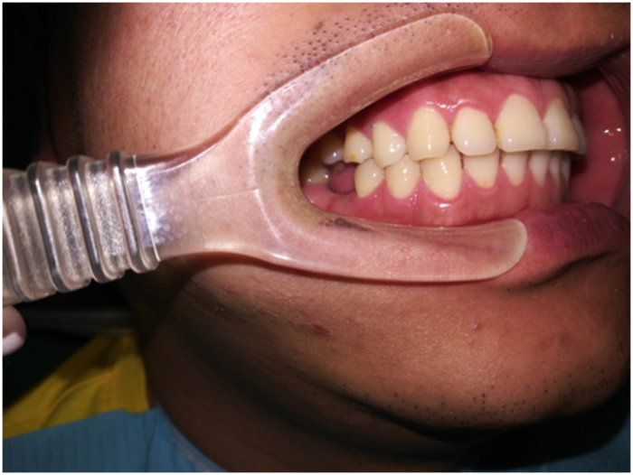 单颗牙缺失一年,怎样修复才能做到几十年不掉?