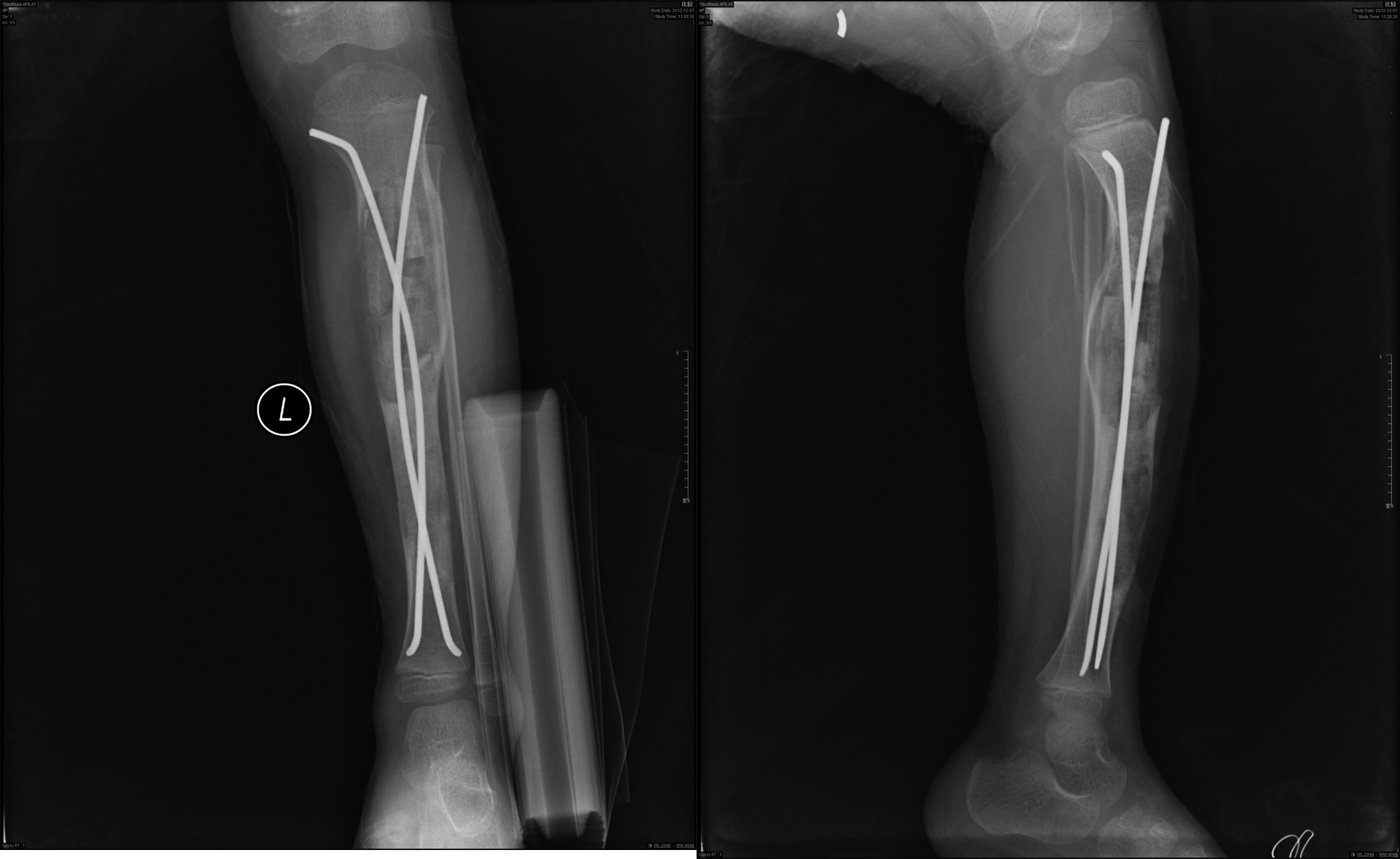 一例骨纤维结构不良的临床诊治过程