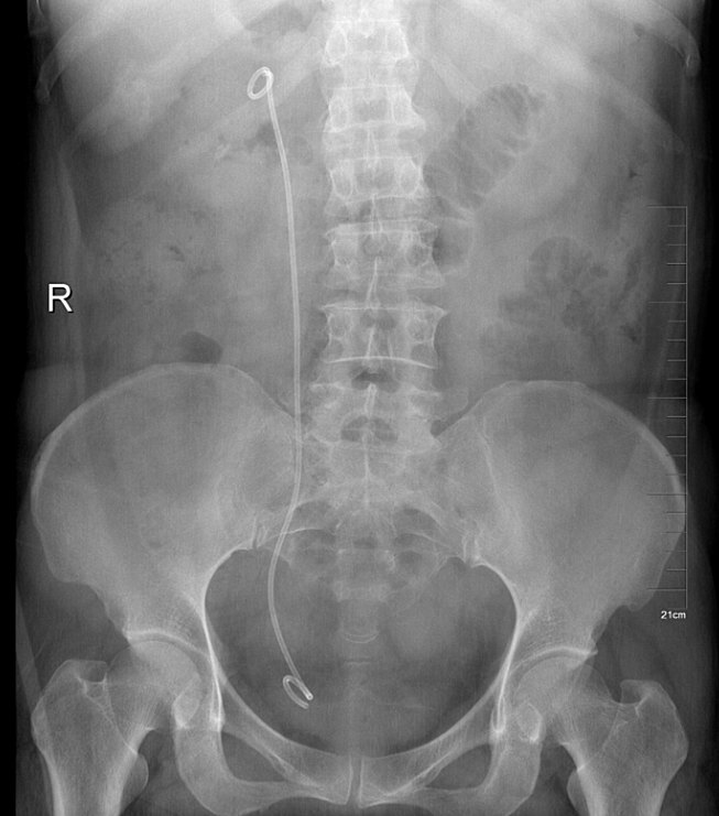 输尿管镜下钬激光碎石术的注意事项