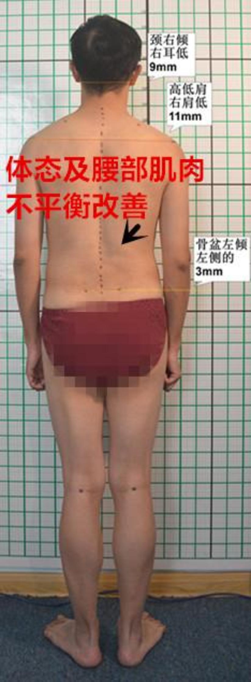 慢性颈腰痛的功能训练复健避免复发加重 病例介绍 健康号 微医