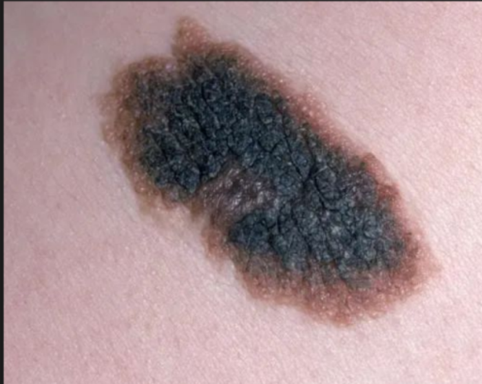 如何判断痣的良恶性