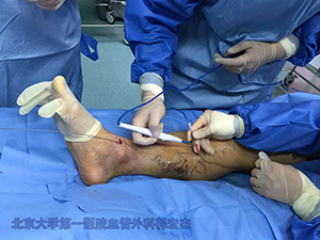 微创剥脱电凝怎么治好下肢静脉曲张