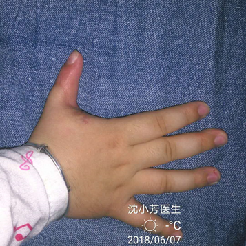 桡侧多指复拇畸形的常见分型及治疗