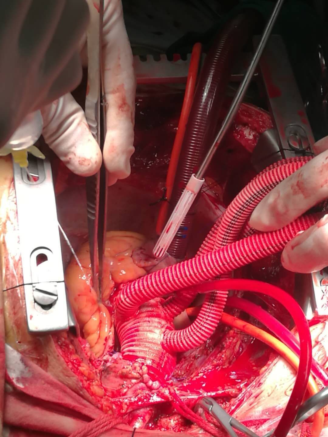 主动脉夹层手术方式图片