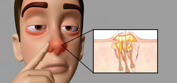 鼻子外面红红的一按就疼,是啥情况?