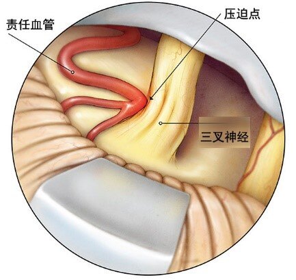 三叉神经痛的外科手术治疗方法 - 微医(挂号网)