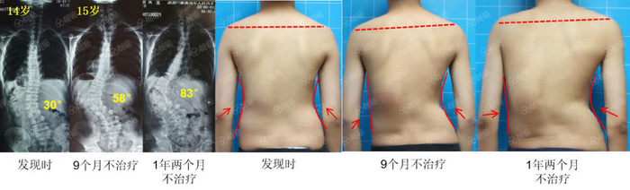 儿童节特供警惕青少年脊柱侧弯建议家长这样做