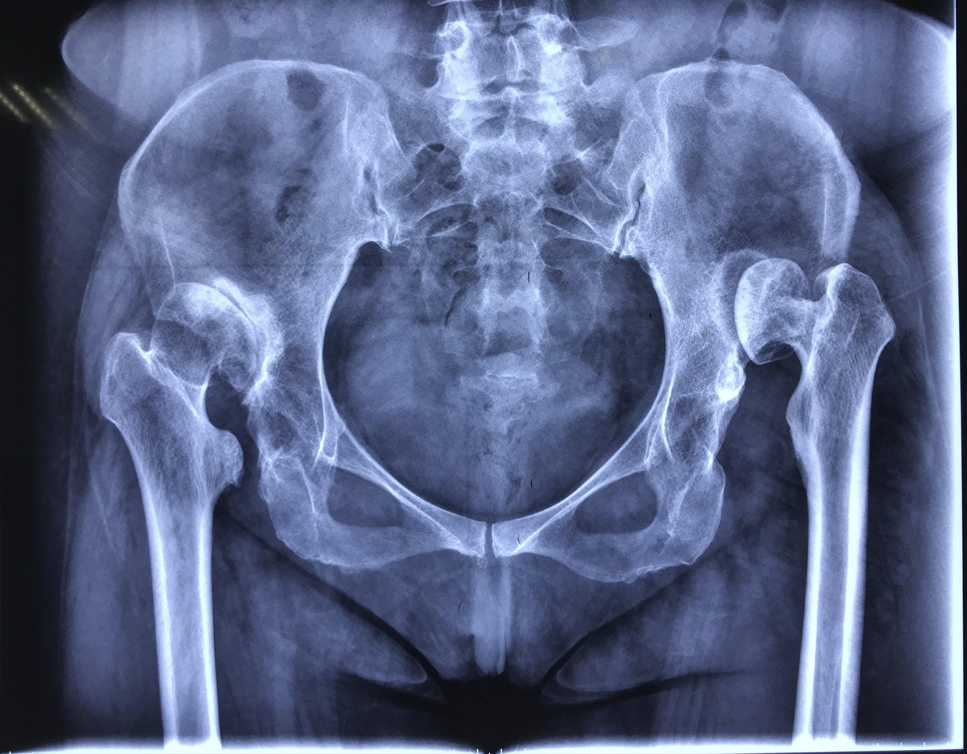 髋关节发育不良Ⅳ型高脱位截骨关节置换手术