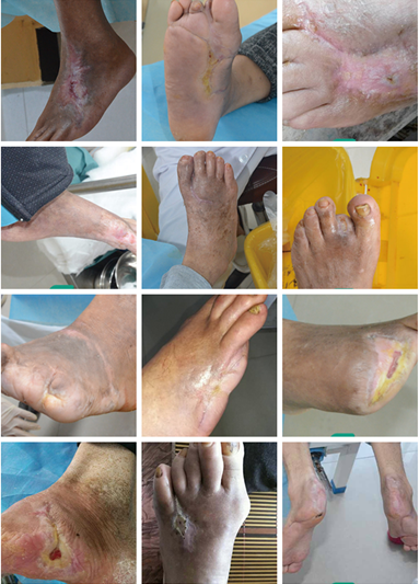 怎样治疗才能控制糖尿病足不让它发展? - 微医(挂号网)