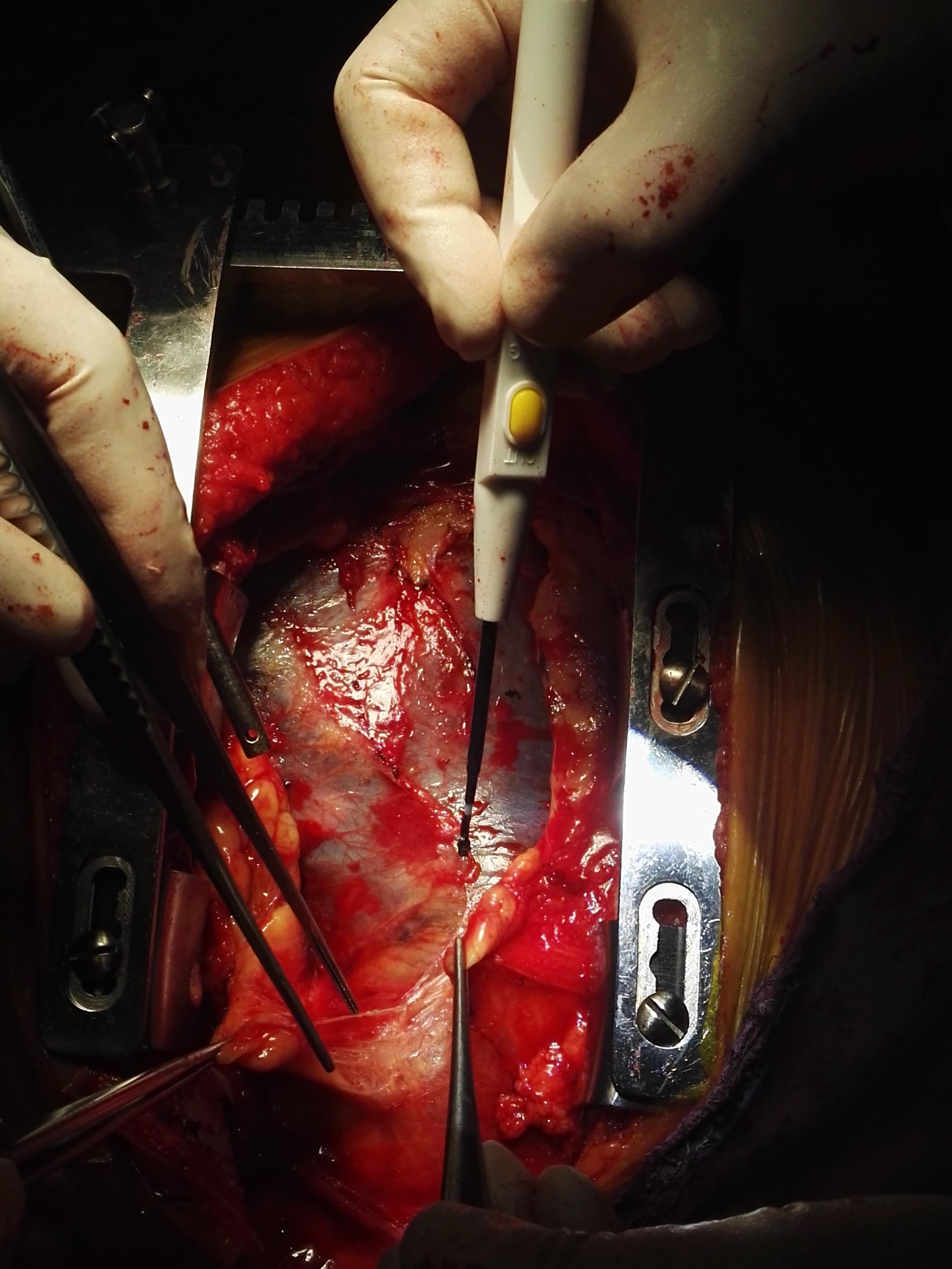 包大量鲜血涌出,且血肿渗至心室,2个瓣交界撕脱,行瓣膜成形 孙氏手术