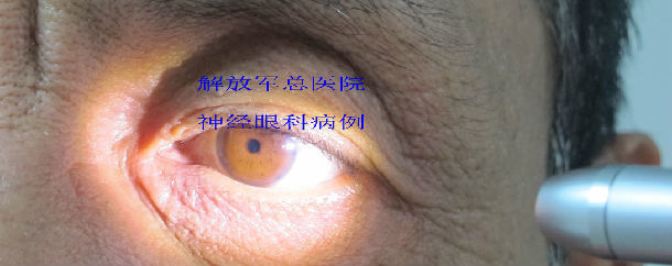 argyllroberston瞳孔神经梅毒一例