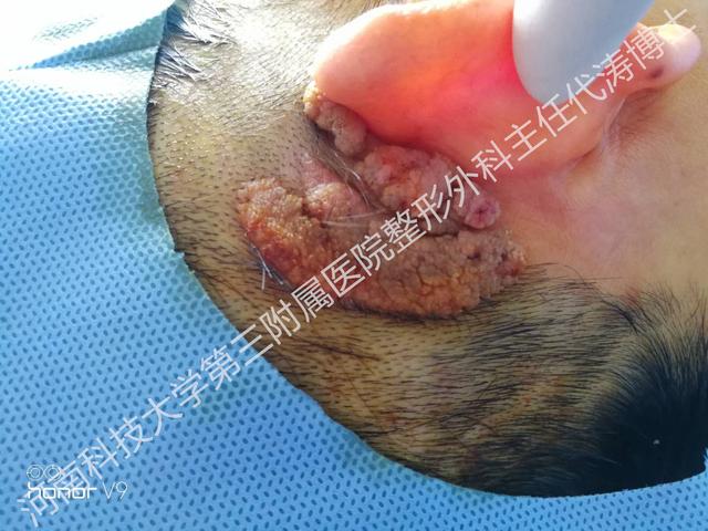 代涛博士皮脂腺痣让人皮不起来