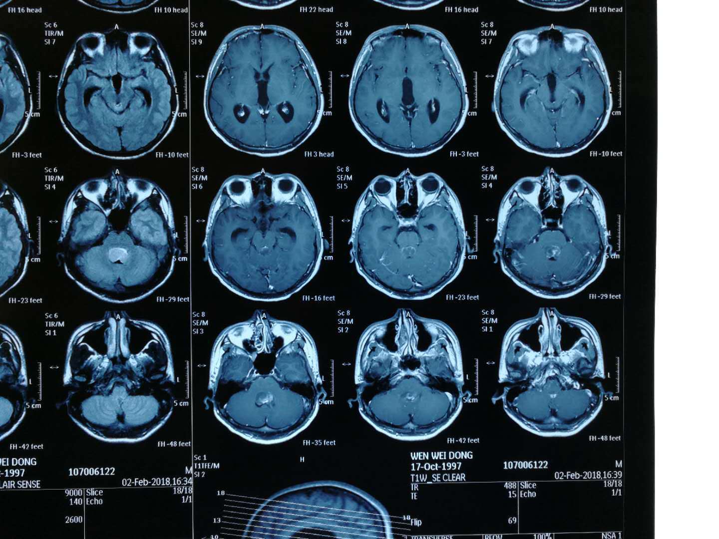 頭顱核磁共振(mri)檢查:四腦室腫瘤,不均勻增強,上達中腦導水管下口