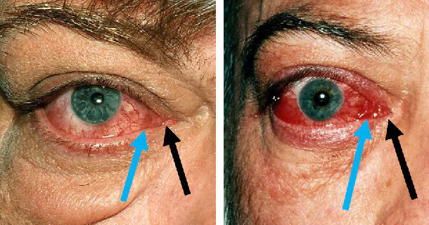 甲状腺相关眼病的临床活动性