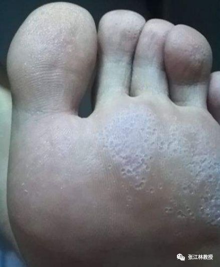 脚气用醋泡真的有效吗?_张江林医生文章_深圳市人民医院-微医(挂号网)