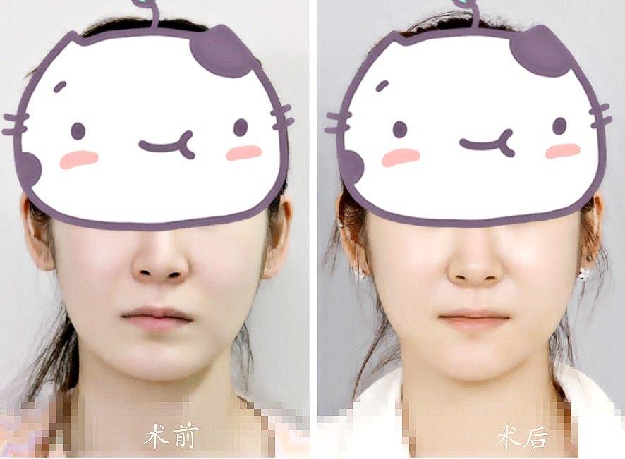 面部轮廓整形之颏成形
