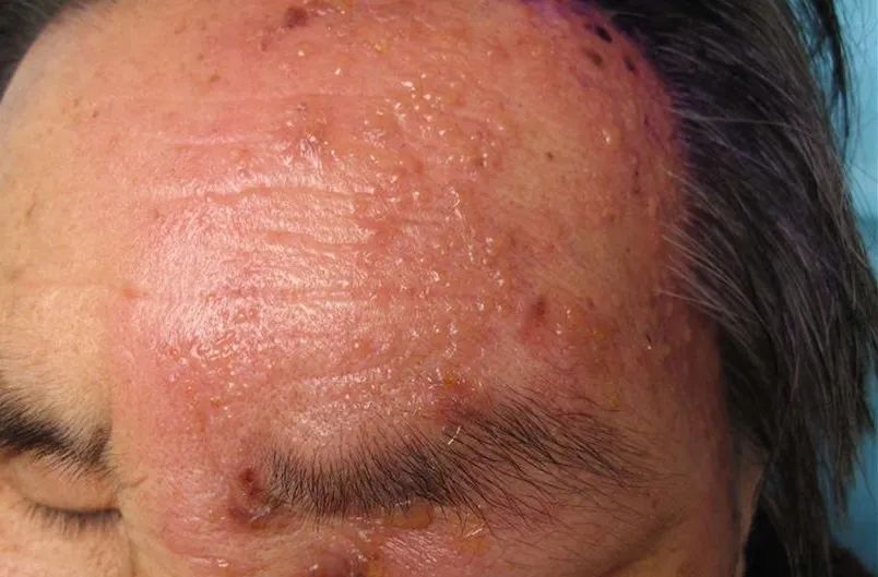 超痛的皮肤病带状疱疹