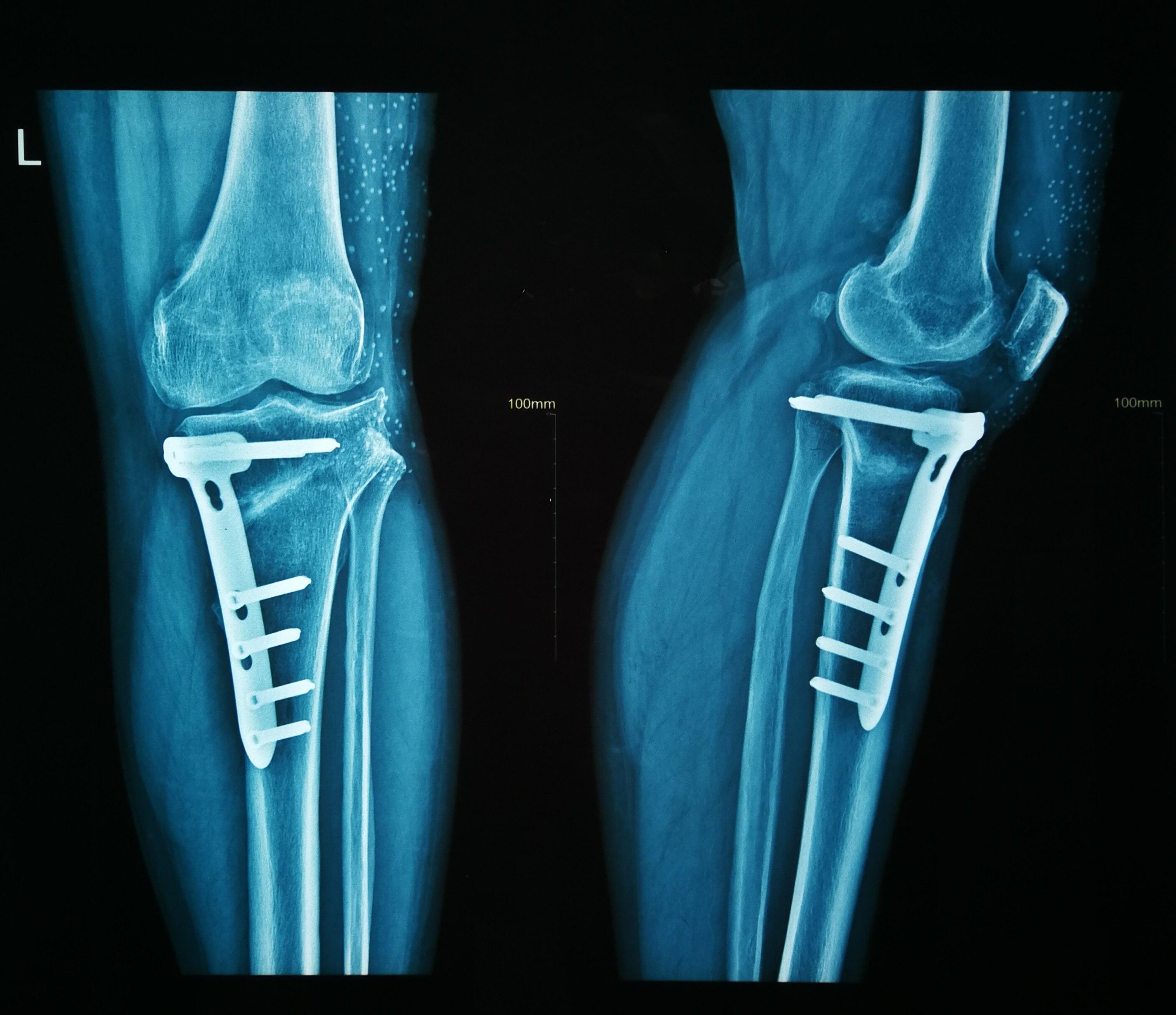 【科普】膝关节置换术后正确的练习方法