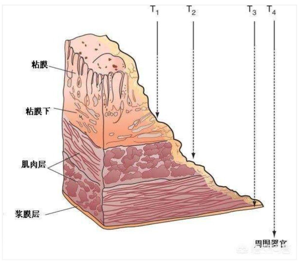 肠壁分为四层,从里向外分别为粘膜层,粘膜下层,肌层,浆膜层.