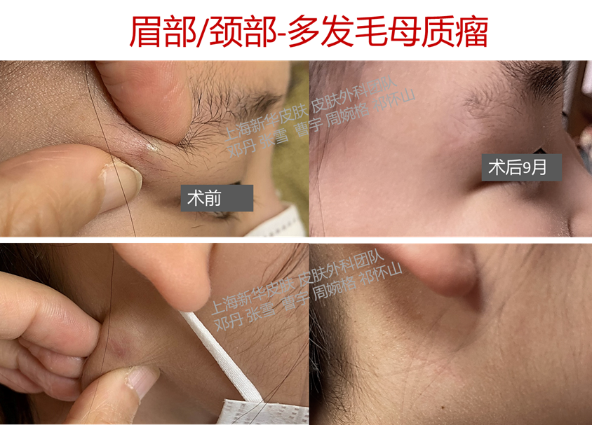 宝宝脸上的蚊子包消不下去?容易误诊的毛母质瘤