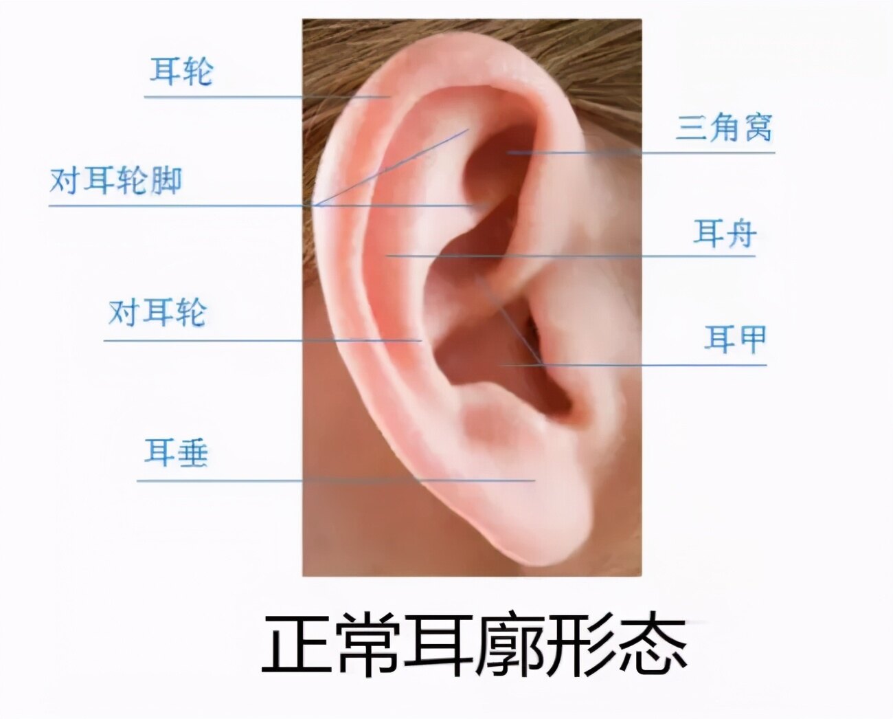 新生儿耳廓畸形,宝爸宝妈们常常忽视而错过了最佳治疗时间