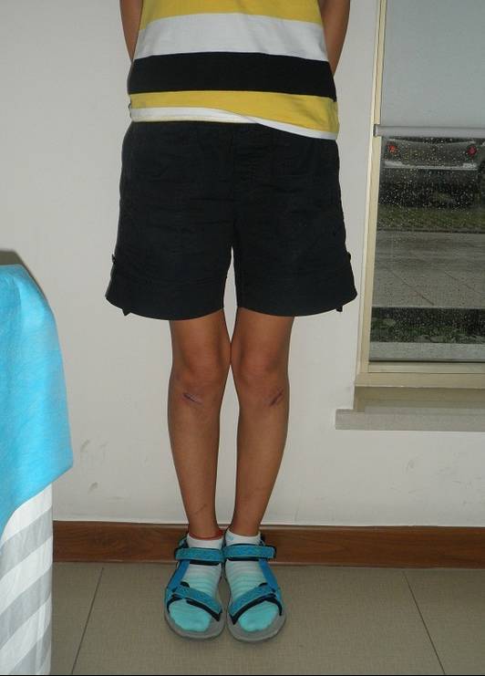 术后:术前:下面为大家分享一个0型腿患者的术前,术后对比照片:小编要