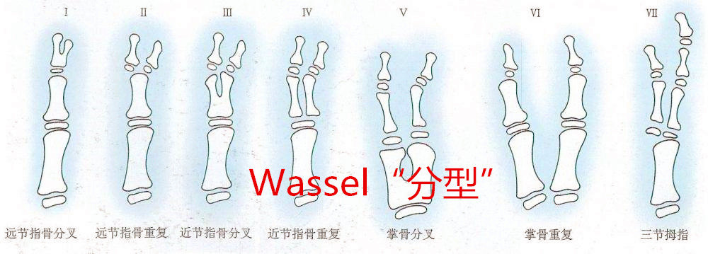 1969年wassel医生对拇指多指畸形进行了"分型",他的这种"7种类型的分