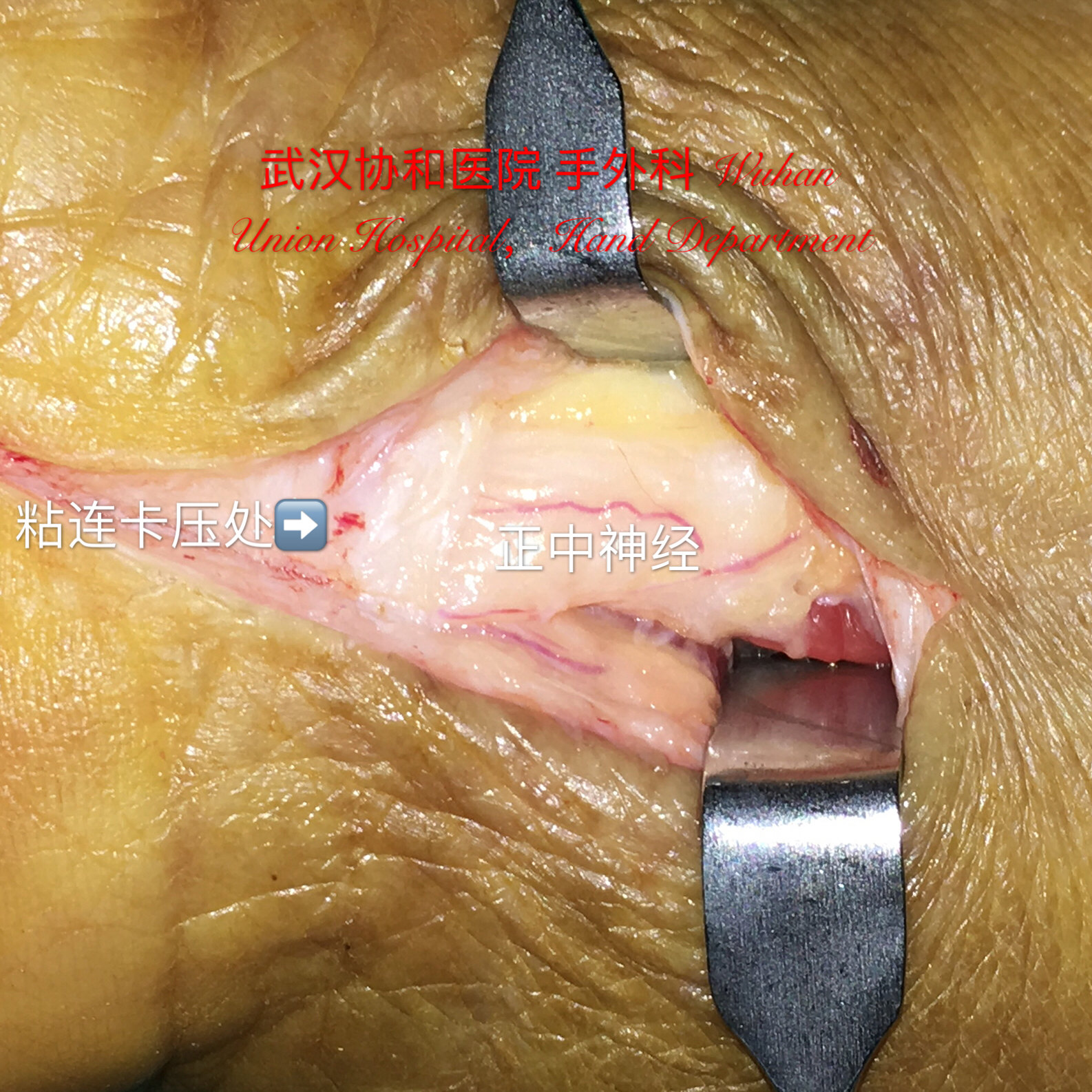 腕管综合征的切口问题