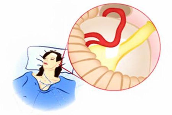 面肌痉挛和面瘫是什么有什么区别