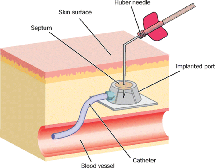 输液时直接将特制的无损伤蝶翼针插入港体即可完成各种输液,因其直接