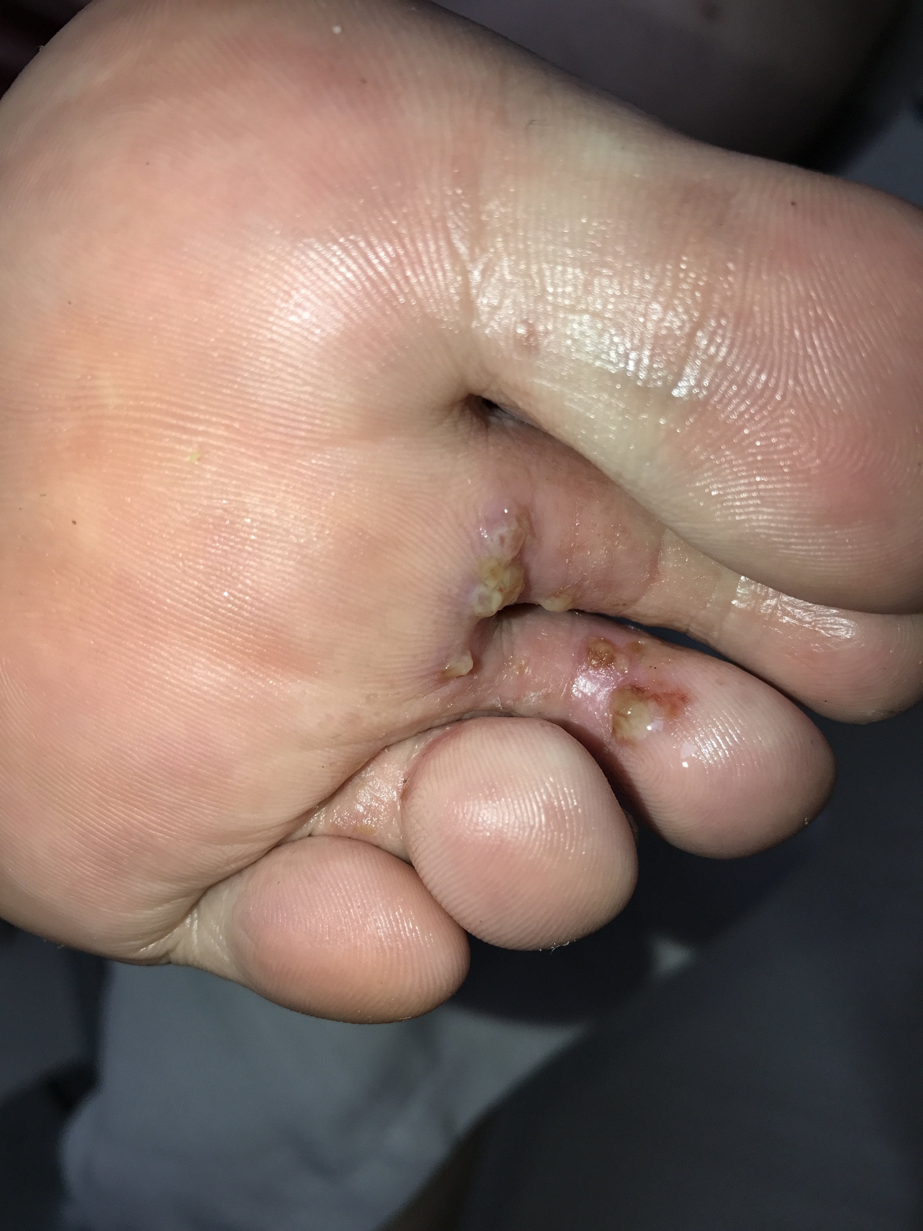手上很多小水泡是汗疱疹医生不是这是脚气导致的