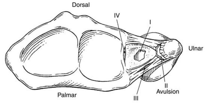 (原创)腕关节疼痛的小朋友要注意排查三角纤维软骨复合体(tfcc)损伤的