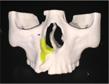 王永前搜狐健康3d打印辅助的齿槽嵴裂修复技术