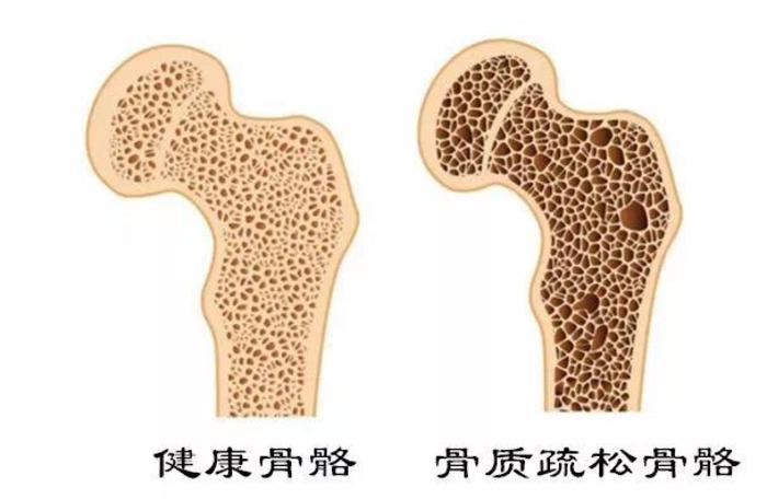 健康骨骼从预防骨质疏松做起