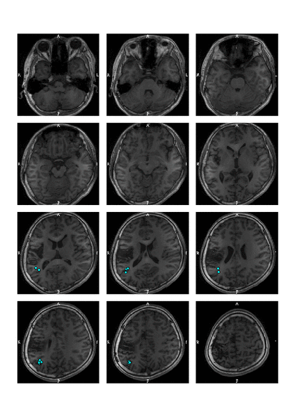 脑磁图清楚地显示出癫痫病灶,在病变的后方脑磁图清晰显示出病变